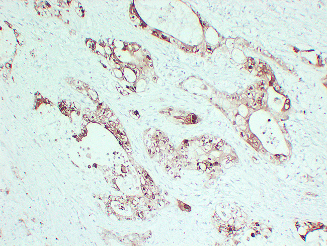 S100P Antibody - Pancreatic Carcinoma 3