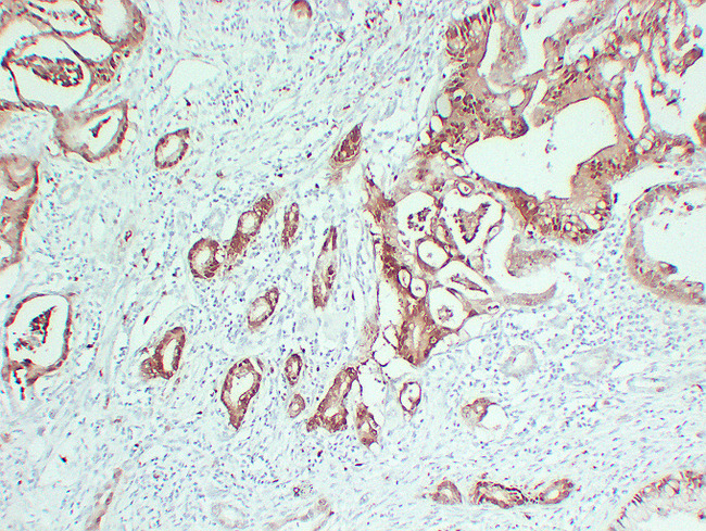 S100P Antibody - Pancreatic Carcinoma 4