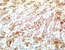S100P Antibody - Immunohistochemical staining of paraffin-embedded human colon cancer using anti-S100P clone UMAB24 mouse monoclonal antibody @ 2 ug/mL with Polink2 Broad HRP DAB detection kit; heat-induced epitope retrieval with Citrate pH6.0