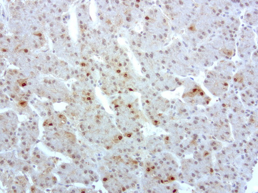 S100P Antibody - Immunohistochemical staining of paraffin-embedded human liver cancer using anti-S100P clone UMAB24 mouse monoclonal antibody  at 1:200 with Polink2 Broad HRP DAB detection kit; heat-induced epitope retrieval with GBI Accel pH8.7 HIER buffer using pressure chamber for 3 minutes at 110C. Nuclear, cytoplasmic, and membrane staining is seen in infiltrating lymphacytes and no staining is tumor cells.
