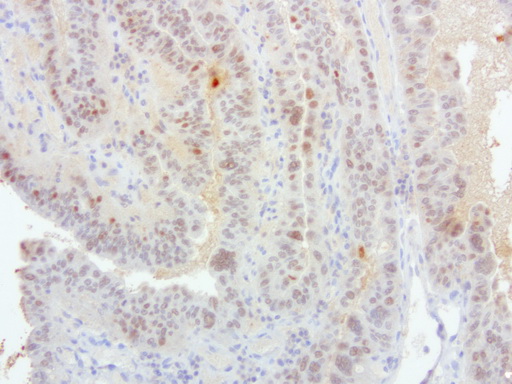 S100P Antibody - Immunohistochemical staining of paraffin-embedded human gastric cancer using anti-S100P clone UMAB24 mouse monoclonal antibody  at 1:200 with Polink2 Broad HRP DAB detection kit; heat-induced epitope retrieval with GBI Accel pH8.7 HIER buffer using pressure chamber for 3 minutes at 110C. Nuclear and cytoplasmic staining is seen in tumor cells.