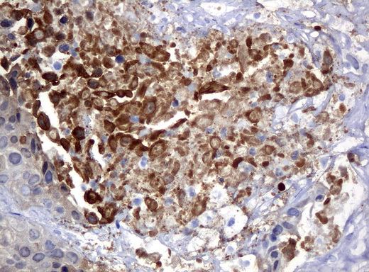 S100P Antibody - Immunohistochemical staining of paraffin-embedded Carcinoma of bladder tissue using anti-S100Pmouse monoclonal antibody. (Clone UMAB24, dilution 1:100; heat-induced epitope retrieval by 10mM citric buffer, pH6.0, 120C for 3min)
