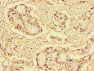 S100P Antibody - Immunohistochemistry of paraffin-embedded human pancreatic cancer at dilution of 1:100