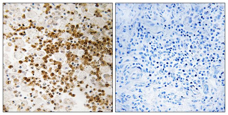 S100P Antibody - Peptide - + Immunohistochemistry analysis of paraffin-embedded human lung carcinoma tissue, using S100P antibody.