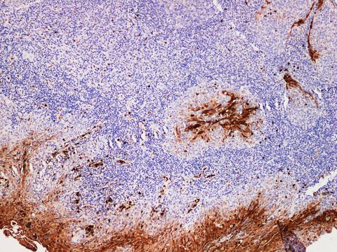 S100P Antibody - Immunohistochemistry of paraffin-embedded Human tonsil using S100P Polyclonal Antibody at dilution of 1:200.