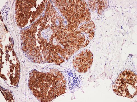 S100P Antibody - Immunohistochemistry of paraffin-embedded Human breast cancer using S100P Polyclonal Antibody at dilution of 1:200(100×).