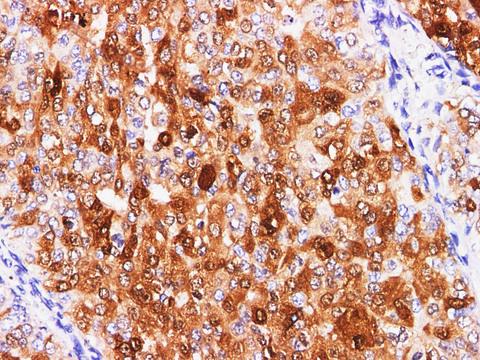 S100P Antibody - Immunohistochemistry of paraffin-embedded Human breast cancer using S100P Polyclonal Antibody at dilution of 1:200(400×).