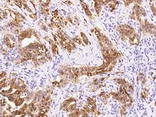 S100P Antibody - Immunochemical staining of human S100P in human pancreatic carcinoma with rabbit polyclonal antibody at 1:1000 dilution, formalin-fixed paraffin embedded sections.