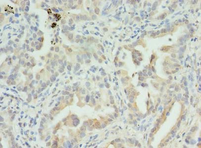 S100PBP Antibody - Immunohistochemistry of paraffin-embedded human lung cancer using antibody at dilution of 1:100.
