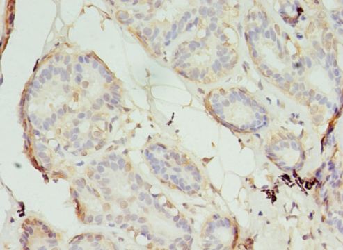 S1PR1 / EDG1 / S1P1 Antibody - Immunohistochemistry of paraffin-embedded human breast cancer using antibody at 1: 100 dilution.  This image was taken for the unconjugated form of this product. Other forms have not been tested.