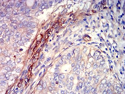 S1PR1 / EDG1 / S1P1 Antibody - Immunohistochemical analysis of paraffin-embedded cervical cancer tissues using CD363 mouse mAb with DAB staining.