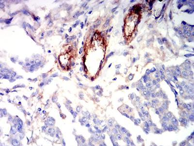 S1PR1 / EDG1 / S1P1 Antibody - Immunohistochemical analysis of paraffin-embedded ovarian cancer tissues using CD363 mouse mAb with DAB staining.