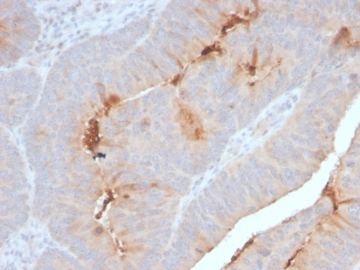 SAA1 / SAA / Serum Amyloid A Antibody - Formalin-fixed, paraffin-embedded human Colon Carcinoma stained with Serum Amyloid A Recombinant Rabbit Monoclonal Antibody (SAA/2868R).