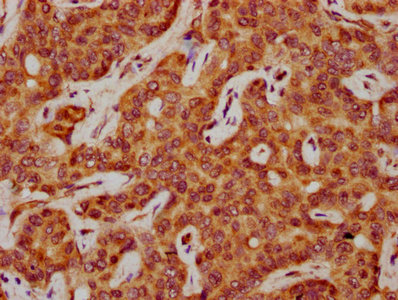 SAA2 / Serum Amyloid A2 Antibody - Immunohistochemistry Dilution at 1:600 and staining in paraffin-embedded human liver cancer performed on a Leica BondTM system. After dewaxing and hydration, antigen retrieval was mediated by high pressure in a citrate buffer (pH 6.0). Section was blocked with 10% normal Goat serum 30min at RT. Then primary antibody (1% BSA) was incubated at 4°C overnight. The primary is detected by a biotinylated Secondary antibody and visualized using an HRP conjugated SP system.