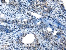 SAA4 Antibody - Immunohistochemistry of paraffin-embedded Human cervical cancer tissue  using SAA4 Polyclonal Antibody at dilution of 1:35(×200)