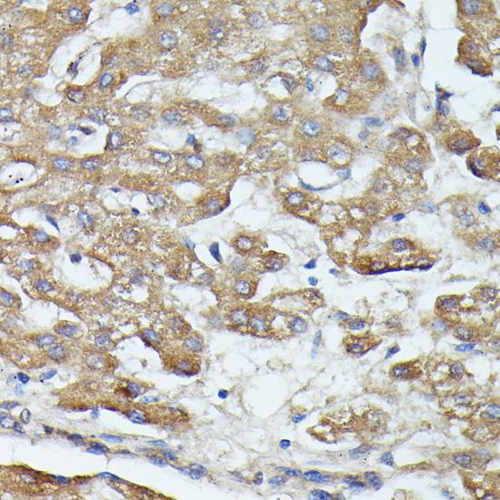 SAA4 Antibody - Immunohistochemistry of paraffin-embedded Human liver cancer using SAA4 Polyclonal Antibody at dilution of 1:100 (40x lens).