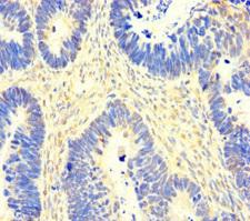 SACM1L / SAC1 Antibody - Immunohistochemistry of paraffin-embedded human ovarian cancer using SACM1L Antibody at dilution of 1:100