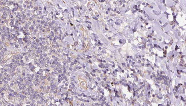 SACM1L / SAC1 Antibody - 1:100 staining human lymph carcinoma tissue by IHC-P. The sample was formaldehyde fixed and a heat mediated antigen retrieval step in citrate buffer was performed. The sample was then blocked and incubated with the antibody for 1.5 hours at 22°C. An HRP conjugated goat anti-rabbit antibody was used as the secondary.