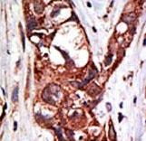 SAE1 Antibody - Formalin-fixed and paraffin-embedded human cancer tissue reacted with the primary antibody, which was peroxidase-conjugated to the secondary antibody, followed by DAB staining. This data demonstrates the use of this antibody for immunohistochemistry; clinical relevance has not been evaluated. BC = breast carcinoma; HC = hepatocarcinoma.