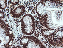 SAE1 Antibody - IHC of paraffin-embedded Adenocarcinoma of Human colon tissue using anti-SAE1 mouse monoclonal antibody.