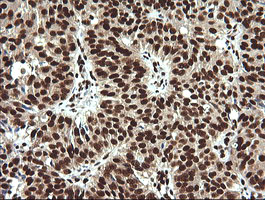 SAE1 Antibody - IHC of paraffin-embedded Adenocarcinoma of Human ovary tissue using anti-SAE1 mouse monoclonal antibody.