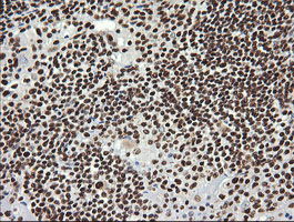 SAE1 Antibody - IHC of paraffin-embedded Human lymphoma tissue using anti-SAE1 mouse monoclonal antibody.