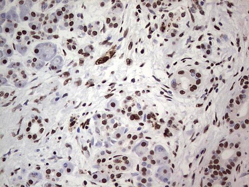 SAE1 Antibody - Immunohistochemical staining of paraffin-embedded Carcinoma of Human pancreas tissue using anti-SAE1 mouse monoclonal antibody. (Heat-induced epitope retrieval by 1 mM EDTA in 10mM Tris, pH8.5, 120C for 3min,