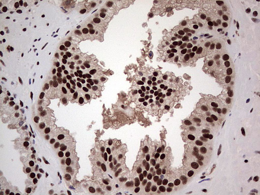 SAE1 Antibody - Immunohistochemical staining of paraffin-embedded Carcinoma of Human prostate tissue using anti-SAE1 mouse monoclonal antibody. (Heat-induced epitope retrieval by 1 mM EDTA in 10mM Tris, pH8.5, 120C for 3min,