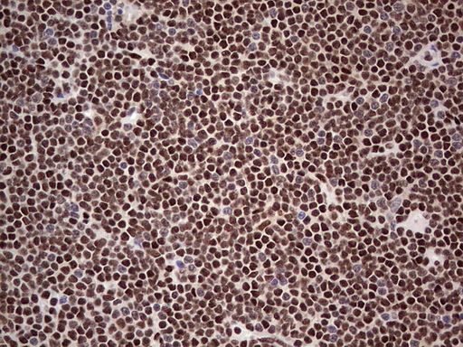 SAE1 Antibody - Immunohistochemical staining of paraffin-embedded Human lymphoma tissue using anti-SAE1 mouse monoclonal antibody. (Heat-induced epitope retrieval by 1 mM EDTA in 10mM Tris, pH8.5, 120C for 3min,