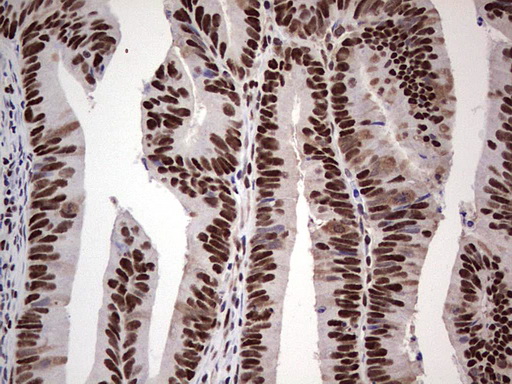 SAE1 Antibody - Immunohistochemical staining of paraffin-embedded Adenocarcinoma of Human colon tissue using anti-SAE1 mouse monoclonal antibody. (Heat-induced epitope retrieval by 1 mM EDTA in 10mM Tris, pH8.5, 120C for 3min,