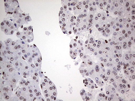 SAE1 Antibody - Immunohistochemical staining of paraffin-embedded Carcinoma of Human liver tissue using anti-SAE1 mouse monoclonal antibody. (Heat-induced epitope retrieval by 1 mM EDTA in 10mM Tris, pH8.5, 120C for 3min,