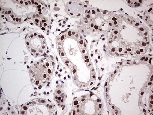 SAE1 Antibody - IHC of paraffin-embedded Human breast tissue using anti-SAE1 mouse monoclonal antibody. (Heat-induced epitope retrieval by 1 mM EDTA in 10mM Tris, pH8.5, 120°C for 3min).