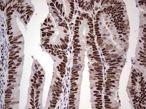 SAE1 Antibody - IHC of paraffin-embedded Adenocarcinoma of Human colon tissue using anti-SAE1 mouse monoclonal antibody. (Heat-induced epitope retrieval by 1 mM EDTA in 10mM Tris, pH8.5, 120°C for 3min).