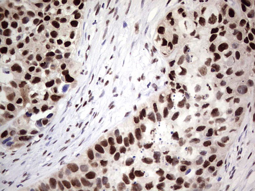 SAE1 Antibody - IHC of paraffin-embedded Carcinoma of Human kidney tissue using anti-SAE1 mouse monoclonal antibody. (Heat-induced epitope retrieval by 1 mM EDTA in 10mM Tris, pH8.5, 120°C for 3min).