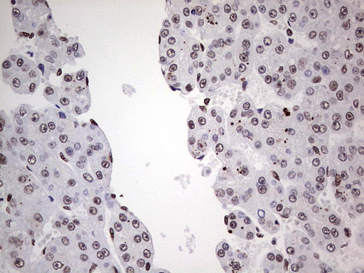 SAE1 Antibody - IHC of paraffin-embedded Carcinoma of Human liver tissue using anti-SAE1 mouse monoclonal antibody. (Heat-induced epitope retrieval by 1 mM EDTA in 10mM Tris, pH8.5, 120°C for 3min).