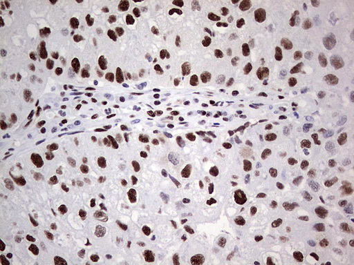 SAE1 Antibody - IHC of paraffin-embedded Carcinoma of Human lung tissue using anti-SAE1 mouse monoclonal antibody. (Heat-induced epitope retrieval by 1 mM EDTA in 10mM Tris, pH8.5, 120°C for 3min).