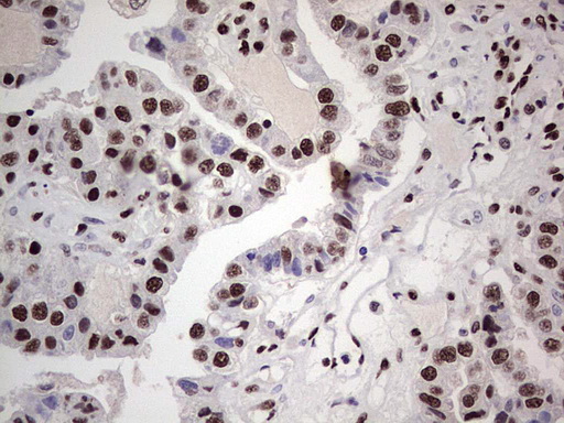 SAE1 Antibody - IHC of paraffin-embedded Adenocarcinoma of Human ovary tissue using anti-SAE1 mouse monoclonal antibody. (Heat-induced epitope retrieval by 1 mM EDTA in 10mM Tris, pH8.5, 120°C for 3min).