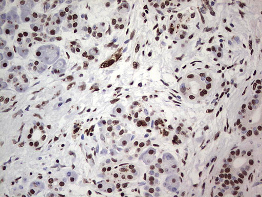 SAE1 Antibody - IHC of paraffin-embedded Carcinoma of Human pancreas tissue using anti-SAE1 mouse monoclonal antibody. (Heat-induced epitope retrieval by 1 mM EDTA in 10mM Tris, pH8.5, 120°C for 3min).