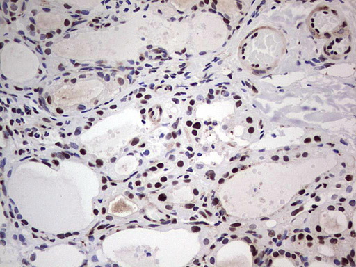 SAE1 Antibody - IHC of paraffin-embedded Human thyroid tissue using anti-SAE1 mouse monoclonal antibody. (Heat-induced epitope retrieval by 1 mM EDTA in 10mM Tris, pH8.5, 120°C for 3min).