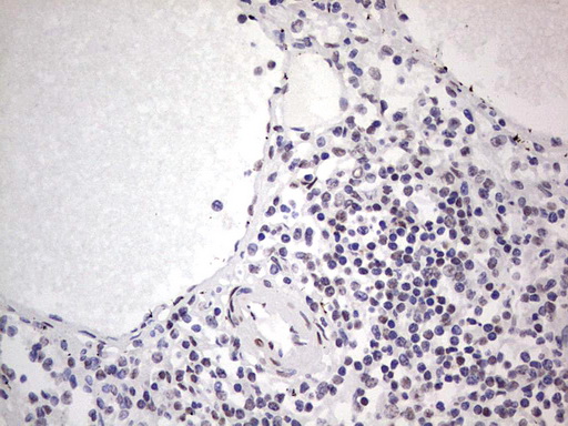 SAE1 Antibody - IHC of paraffin-embedded Carcinoma of Human thyroid tissue using anti-SAE1 mouse monoclonal antibody. (Heat-induced epitope retrieval by 1 mM EDTA in 10mM Tris, pH8.5, 120°C for 3min).