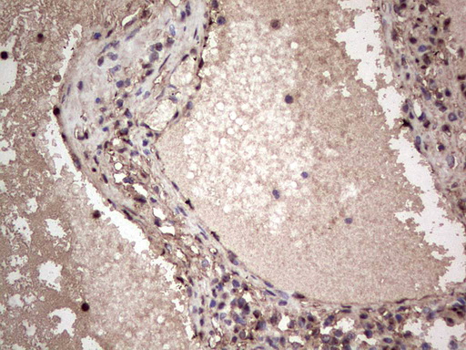 SAE1 Antibody - Immunohistochemical staining of paraffin-embedded Carcinoma of Human thyroid tissue using anti-SAE1 mouse monoclonal antibody. (Heat-induced epitope retrieval by 1 mM EDTA in 10mM Tris, pH8.5, 120C for 3min,