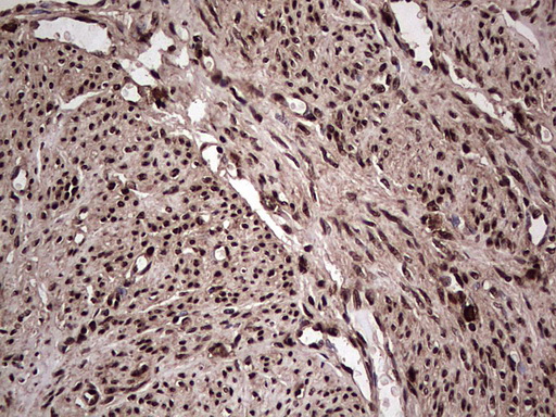 SAE1 Antibody - Immunohistochemical staining of paraffin-embedded Adenocarcinoma of Human endometrium tissue using anti-SAE1 mouse monoclonal antibody. (Heat-induced epitope retrieval by 1 mM EDTA in 10mM Tris, pH8.5, 120C for 3min,
