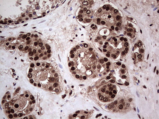 SAE1 Antibody - Immunohistochemical staining of paraffin-embedded Carcinoma of Human prostate tissue using anti-SAE1 mouse monoclonal antibody. (Heat-induced epitope retrieval by 1 mM EDTA in 10mM Tris, pH8.5, 120C for 3min,