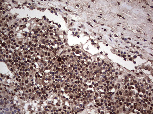 SAE1 Antibody - Immunohistochemical staining of paraffin-embedded Carcinoma of Human bladder tissue using anti-SAE1 mouse monoclonal antibody. (Heat-induced epitope retrieval by 1 mM EDTA in 10mM Tris, pH8.5, 120C for 3min,