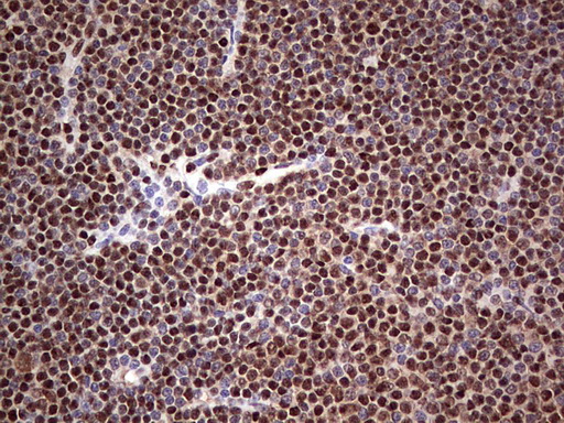 SAE1 Antibody - Immunohistochemical staining of paraffin-embedded Human lymphoma tissue using anti-SAE1 mouse monoclonal antibody. (Heat-induced epitope retrieval by 1 mM EDTA in 10mM Tris, pH8.5, 120C for 3min,