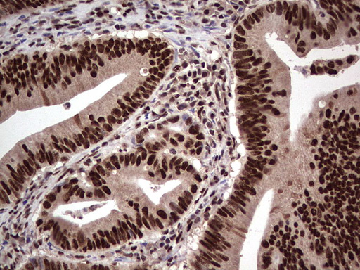 SAE1 Antibody - Immunohistochemical staining of paraffin-embedded Adenocarcinoma of Human colon tissue using anti-SAE1 mouse monoclonal antibody. (Heat-induced epitope retrieval by 1 mM EDTA in 10mM Tris, pH8.5, 120C for 3min,