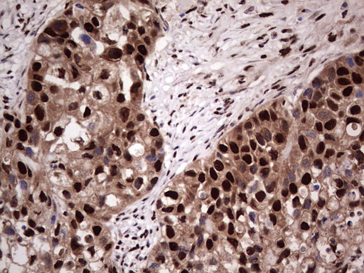 SAE1 Antibody - Immunohistochemical staining of paraffin-embedded Carcinoma of Human kidney tissue using anti-SAE1 mouse monoclonal antibody. (Heat-induced epitope retrieval by 1 mM EDTA in 10mM Tris, pH8.5, 120C for 3min,