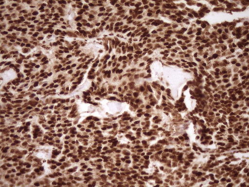 SAE1 Antibody - Immunohistochemical staining of paraffin-embedded Carcinoma of Human lung tissue using anti-SAE1 mouse monoclonal antibody. (Heat-induced epitope retrieval by 1 mM EDTA in 10mM Tris, pH8.5, 120C for 3min,