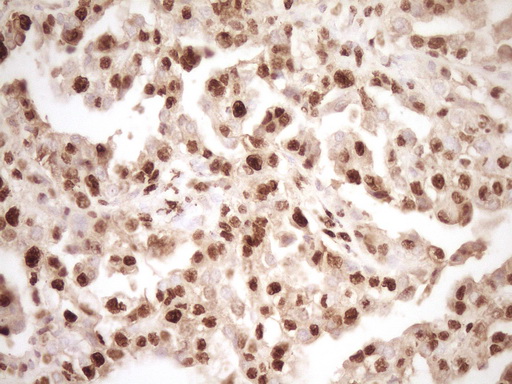 SAE1 Antibody - Immunohistochemical staining of paraffin-embedded Adenocarcinoma of Human ovary tissue using anti-SAE1 mouse monoclonal antibody. (Heat-induced epitope retrieval by 1 mM EDTA in 10mM Tris, pH8.5, 120C for 3min,