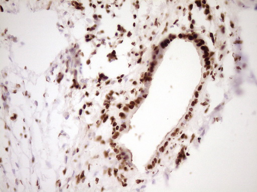 SAE1 Antibody - Immunohistochemical staining of paraffin-embedded Carcinoma of Human pancreas tissue using anti-SAE1 mouse monoclonal antibody. (Heat-induced epitope retrieval by 1 mM EDTA in 10mM Tris, pH8.5, 120C for 3min,